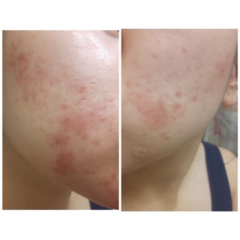 [Acne] [Product Question] Those with experience with Clindoxyl Gel, is ...