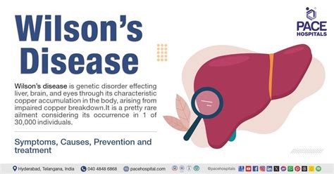 Wilson’s Disease - Symptoms, Causes, Prevention, and Treatment