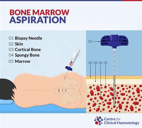 Bone Marrow Biopsy and Bone Marrow Aspiration | CFCH | Centre for Clinical Haematology