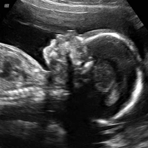 Week 21 Ultrasound: What It Would Look Like