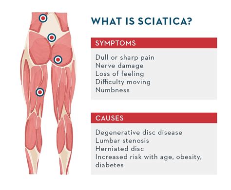 What is sciatica and how to deal with common causes of leg pain? - by MD Thordis Berger