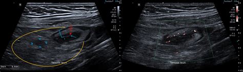 Cross‐sectional images demonstrating terminal ileitis. Left: B mode... | Download Scientific Diagram