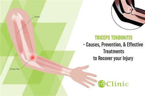 Triceps Tendonitis - Causes, Preventions, and Effective Treatments to ...