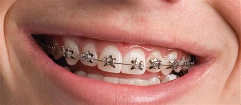 Phases of Orthodontic Treatment | Definitive Dental