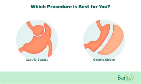 Gastric Sleeve vs. Gastric Bypass: What are the Pros and Cons?