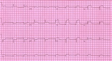 STEMI case examples - wikidoc