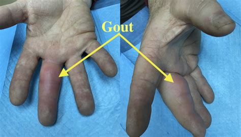 GOUT | Hand Surgery Source