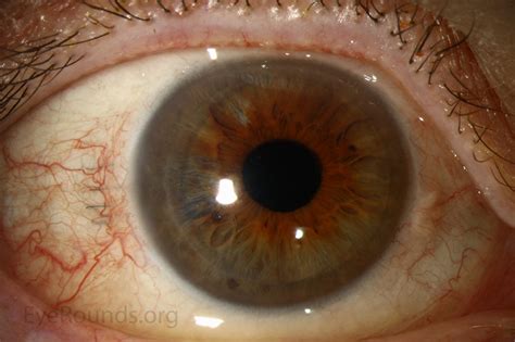 Descemet Stripping Automated Endothelial Keratoplasty (DSAEK)