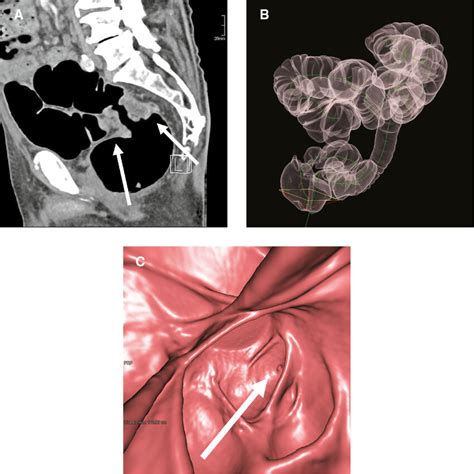 CT colonography after failed colonoscopy because of a stenosing... | Download Scientific Diagram