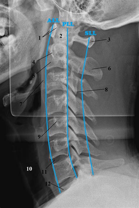 Cervical spine x ray report generator - hoppergolf