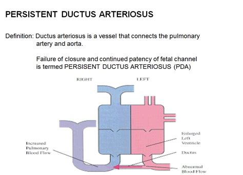 Patent ductus arteriosus pathophysiology - wikidoc