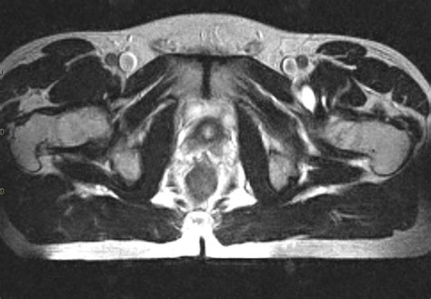 Iliopsoas Bursitis/ Tenditis-MRI - Sumer's Radiology Blog