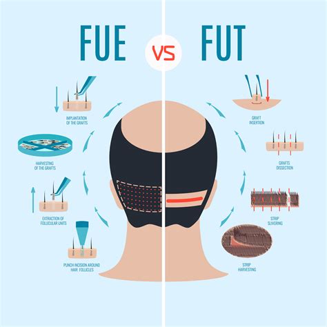 Strip Method Harvesting Hair Transplant VS FUE | Hair Transplant Los Angeles