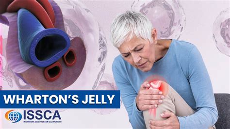 Wharton’s Jelly - how does it work? - ISSCA™. International Society for ...