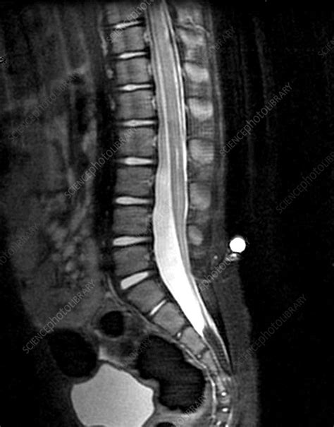 Dermal Sinus and Tethered Cord (MRI) - Stock Image - C027/0898 ...