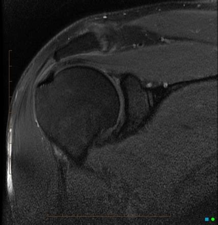 posterior labral tear shoulder mri