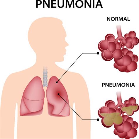 Pneumonia In Ohio 2024 - Tessa Fredelia