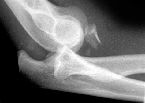 5: Terrible triad of elbow | Download Scientific Diagram