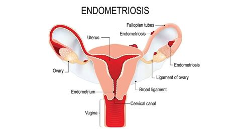 Etonogestrel: Dosage, Mechanism/Onset of Action, Half-Life - Medicine.com