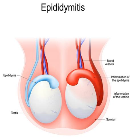 Epididymitis Treatment: With Prompt Attention, You Can Avoid Complications - University Health News