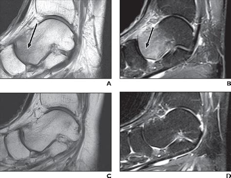 Table 1 from Insufficiency and nondisplaced fractures of the talar head ...