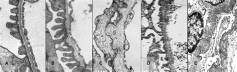 Renal histology in Alport syndrome. ( A ) Normal glomerular... | Download Scientific Diagram