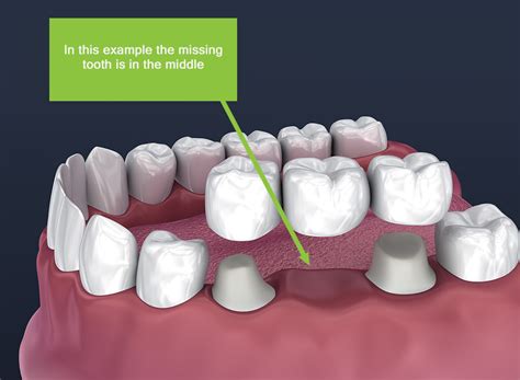 What Are Dental Crowns And Bridges?