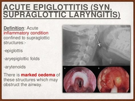 acute epiglottitis,WHAT TO KNOW?