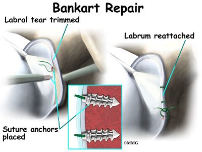 mylartegk - dislocated floating rib symptoms