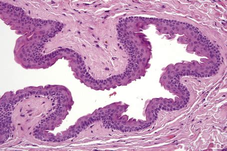 Steatocystoma Multiplex Histology