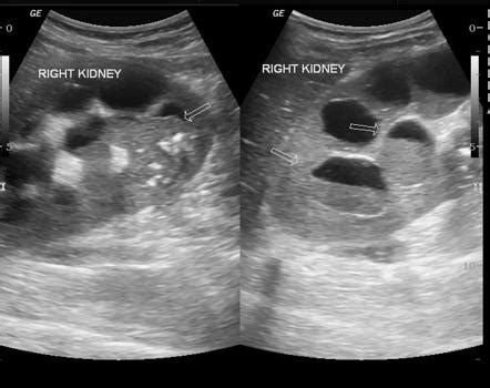 Pyonephrosis Ultrasound