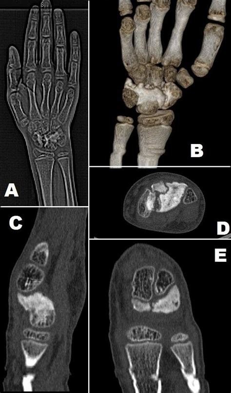 FIGURE LEGEND: CT Scan of right wrist joint of 9 year old male child ...