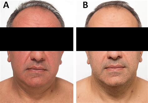 A flushing disorder: A case from the endocrine teaching clinics - Mayo Clinic