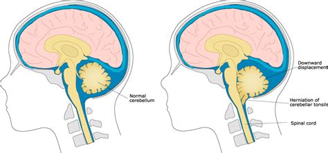 Chiari Malformation Treatment in Thailand - Almurshidi Medical Tourism - Best Affordable ...