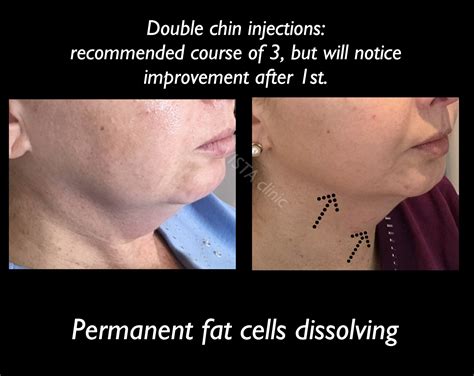 Double Chin/ Fat dissolving - Vista Clinic Melbourne Australia