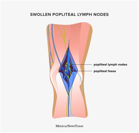 Swollen Lymph Nodes Diagram