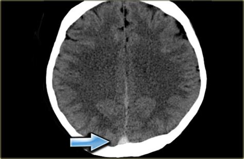 Superior Sagittal Sinus Thrombosis