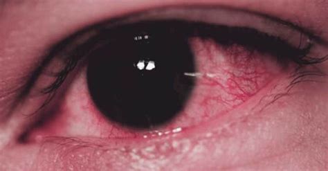 Dry Eye Syndrome: Symptoms, Causes, And Treatment | Marham