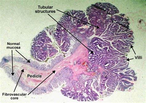 موقع الدكتور أحمد كلحى: صور باثولوجى - ﻿Patholgy Slides : Tumors or Neoplasia