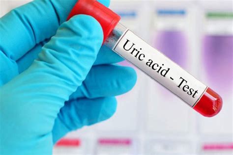 What is Uric Acid Test?