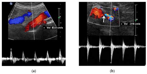 JCM | Free Full-Text | Gray-Scale, Color Doppler, Spectral Doppler, and Contrast-Enhanced Renal ...