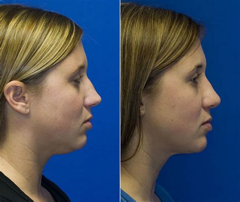 Using neck liposuction to remove a stubborn neck waddle | Seattle Facial Plastic Surgeon| Dr ...