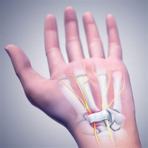 How To Treat Carpal Tunnel Syndrome Without Surgery - Tanya Coats Occupational Therapy