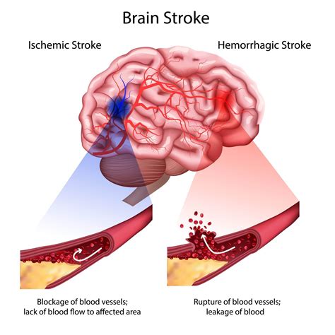 What Does a Stroke-Related Headache Feel Like? - Premier Neurology ...