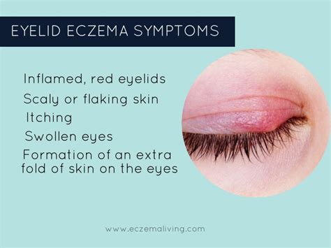 Eyelid Dermatitis - How to Get Rid of Eczema on Eyes?