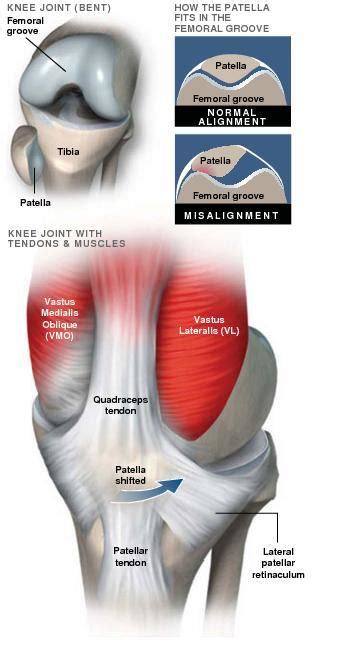 Patellar Tracking Disorder - Sarasota, FL: Schofield, Hand and Bright Orthopaedics