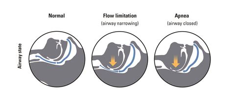 Obstructive Sleep Apnea Diagram