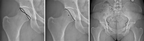 Radiographic signs of acetabular retroversion in AP projections with... | Download Scientific ...