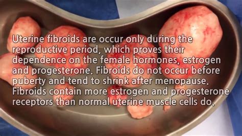 How To Get Rid Of Uterine Fibroids Without Surgery – Otosection