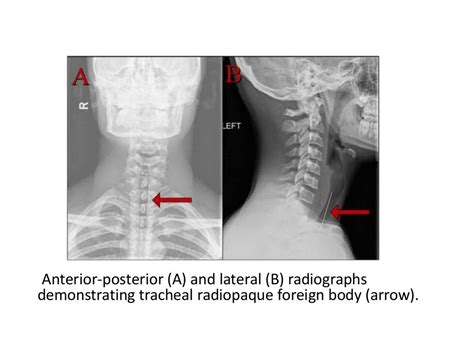 An approach to a case of Paediatric Stridor